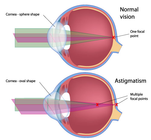 illustration_astigmatism
