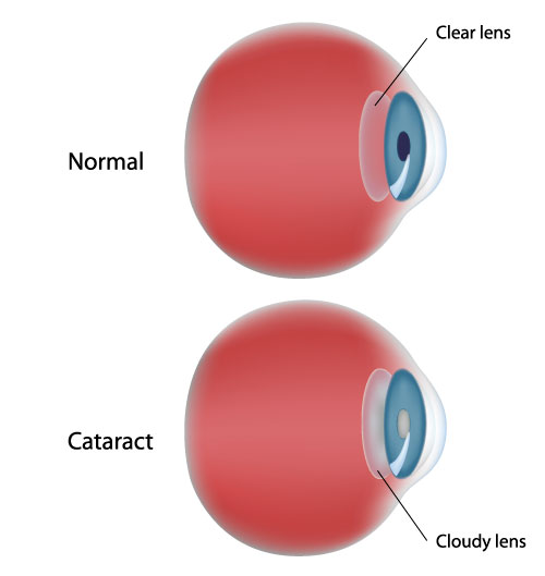 illustration_cataract