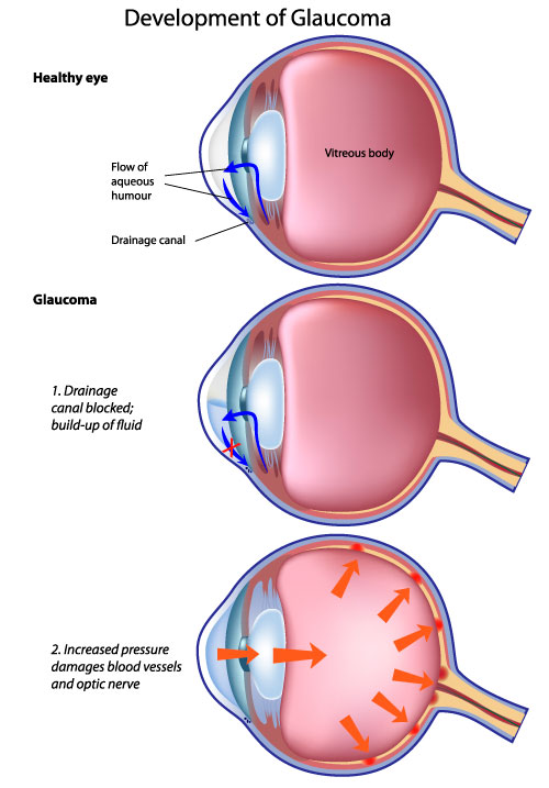 illustration_glaucoma