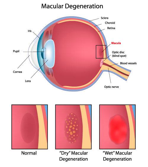 illustration_macular-degeneration