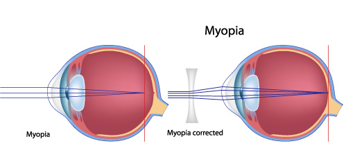 illustration_myopia